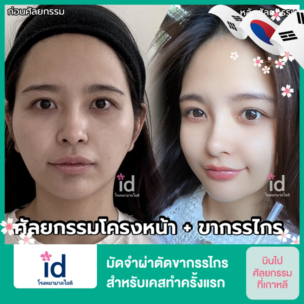 มัดจำผ่าตัดขากรรไกร สำหรับเคสทำครั้งแรก