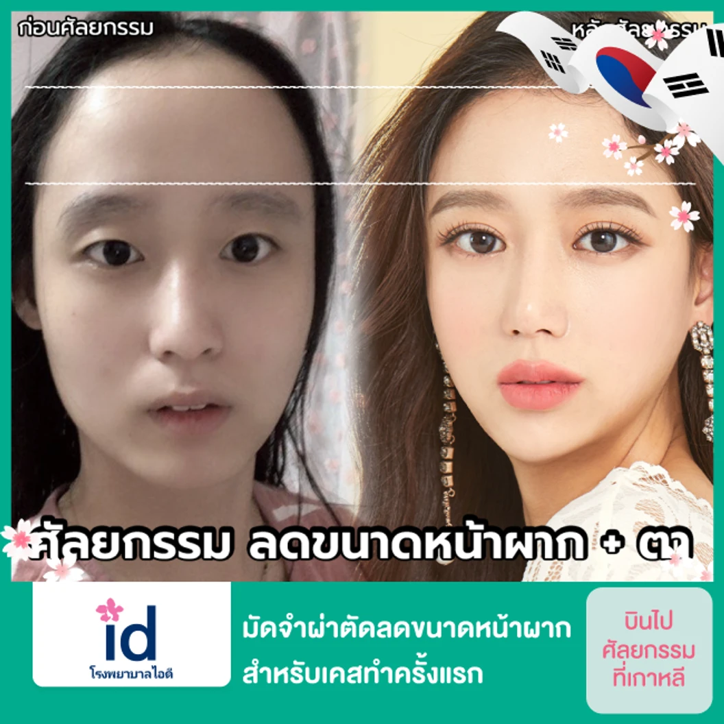มัดจำผ่าตัดลดขนาดหน้าผาก สำหรับเคสทำครั้งแรก