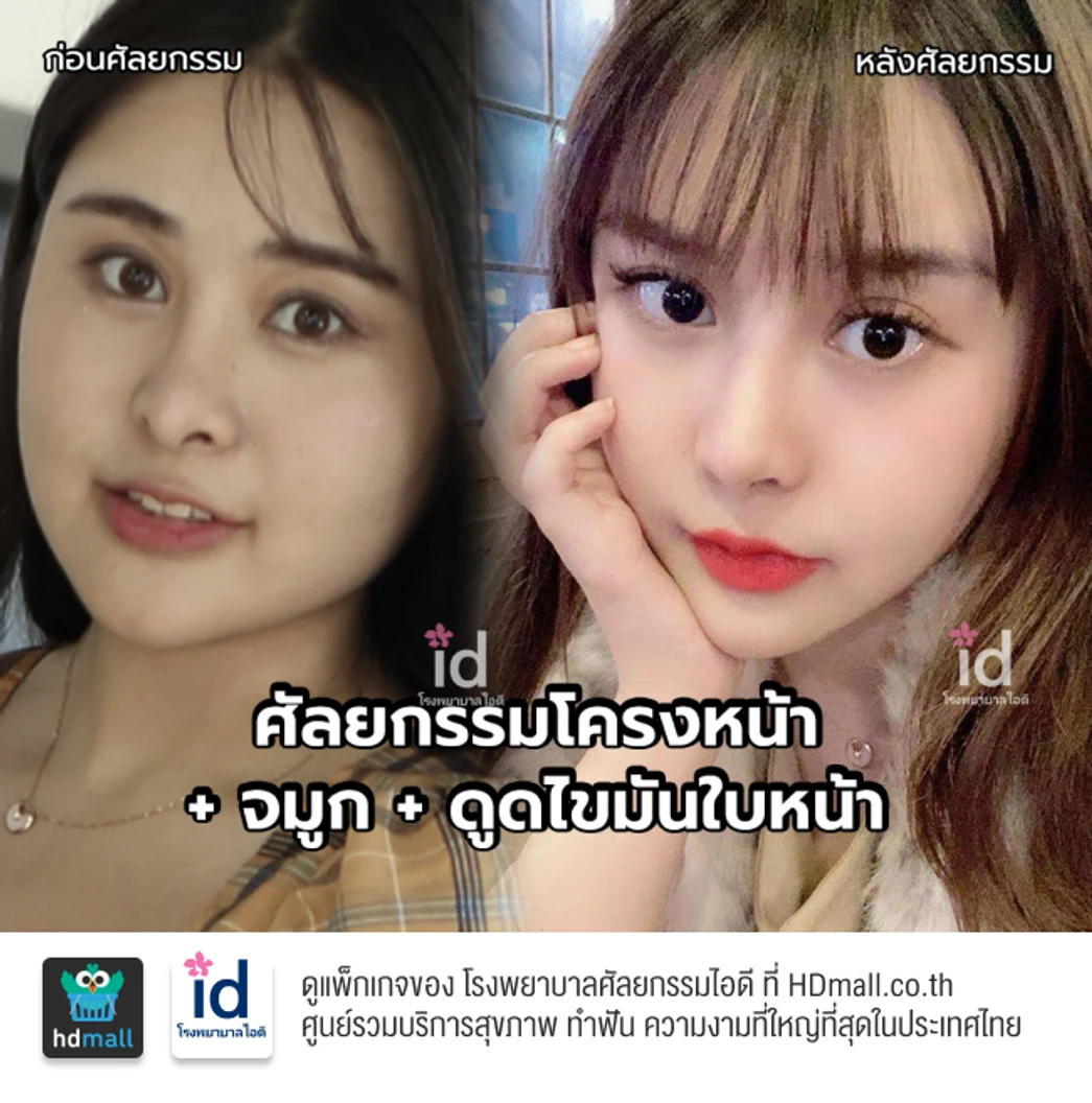 มัดจำดูดไขมันใบหน้า สำหรับเคสทำครั้งแรก