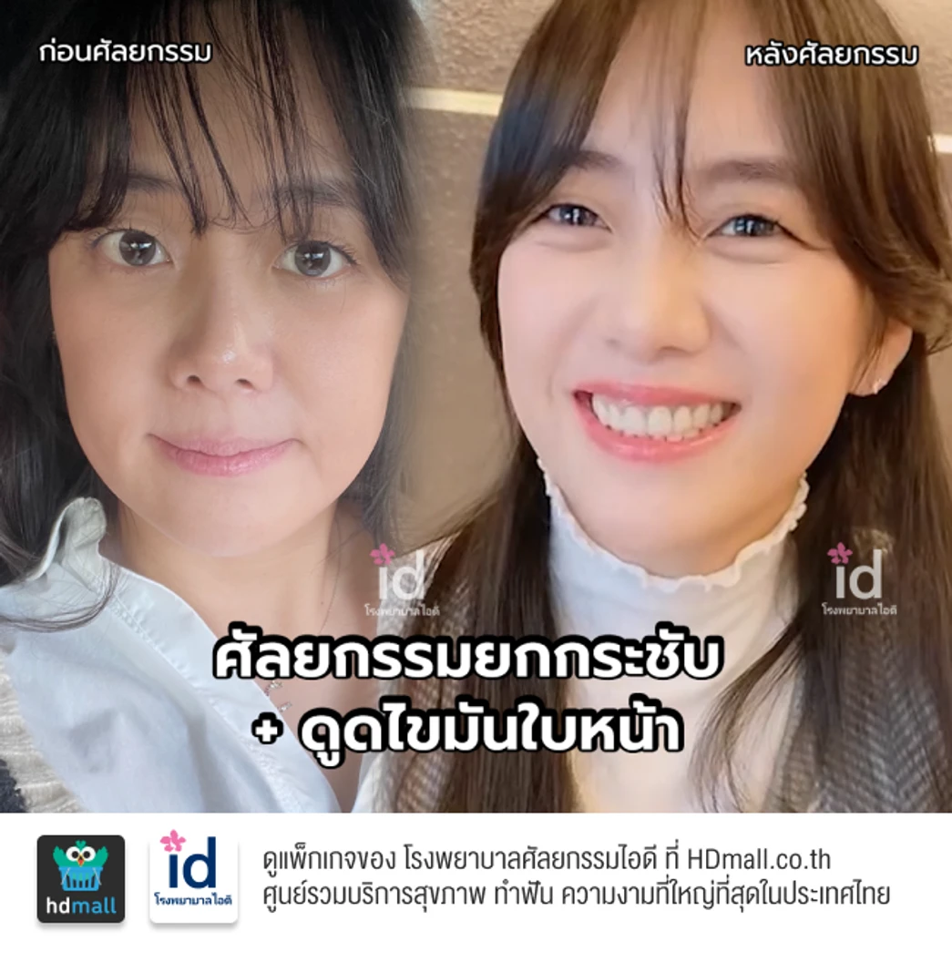 มัดจำดูดไขมันใบหน้า สำหรับเคสทำครั้งแรก