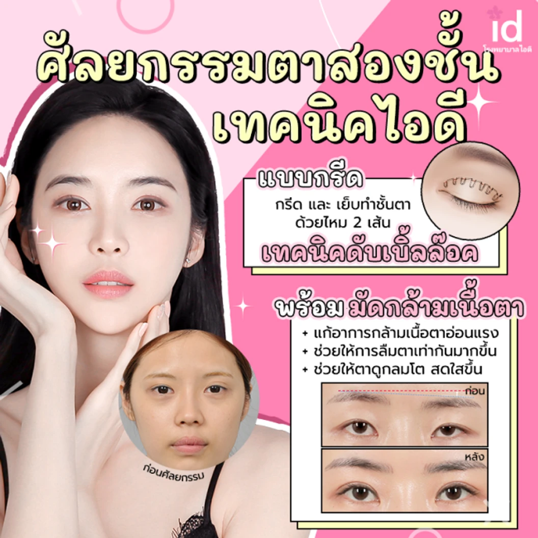 มัดจำทำตาสองชั้น สำหรับเคสทำครั้งแรก