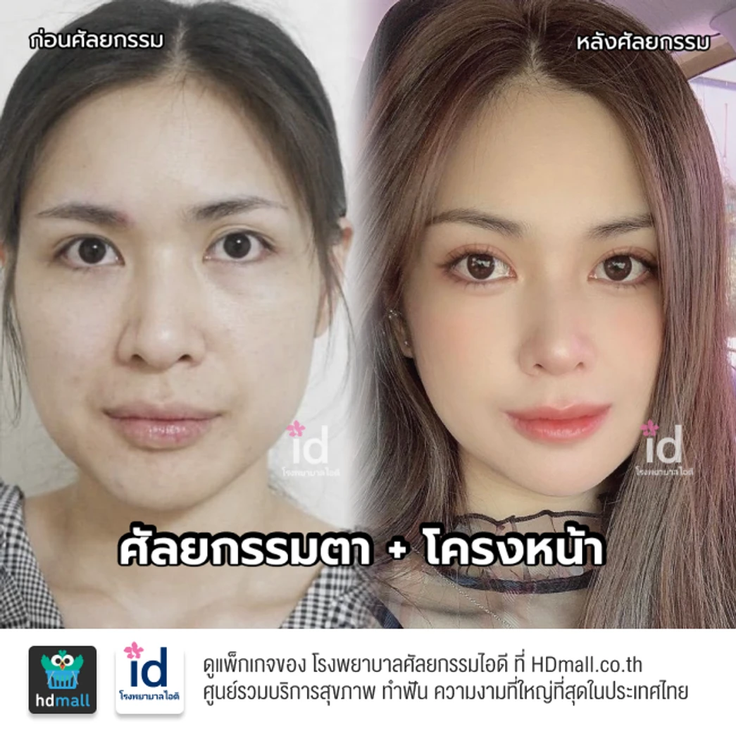 มัดจำทำตาสองชั้น สำหรับเคสทำครั้งแรก