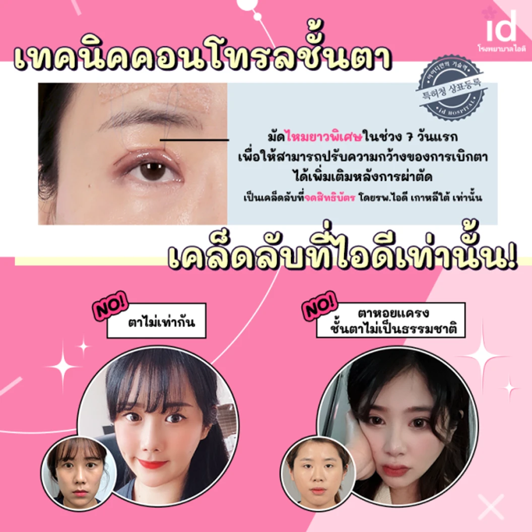 มัดจำศัลยกรรมตาสองชั้น สำหรับเคสแก้