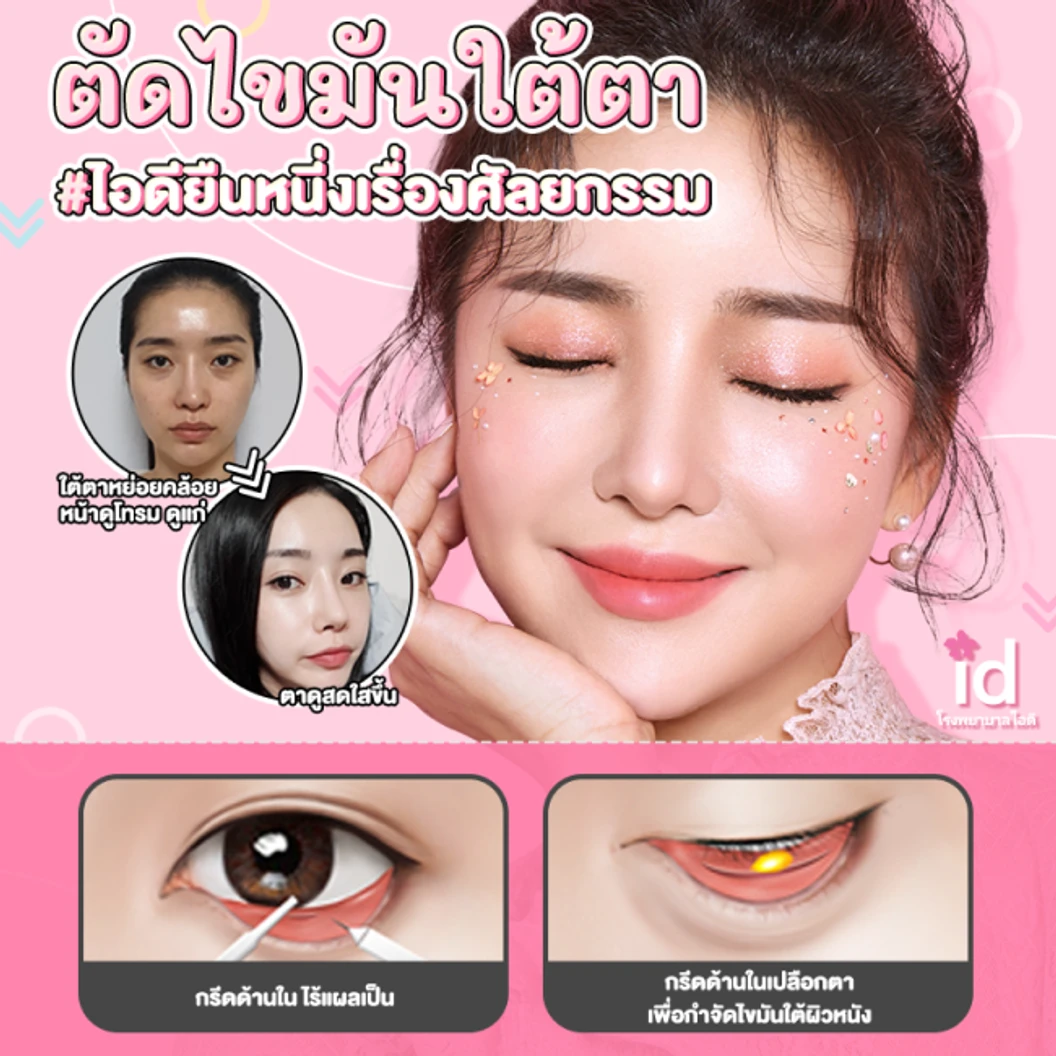 มัดจำจัดเรียงไขมันใต้ตา พร้อมตัดหนังหย่อนคล้อยใต้ตา สำหรับเคสทำครั้งแรก