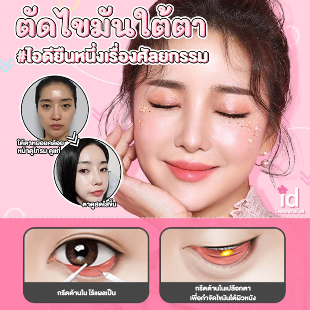 มัดจำผ่าตัดเรียงไขมันใต้ตา สำหรับเคสทำครั้งแรก