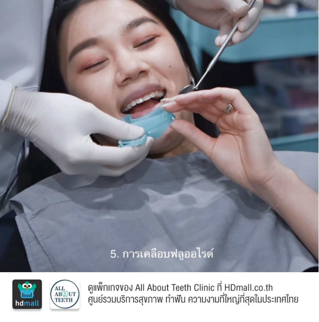 ฟอกสีฟันที่คลินิก ด้วยระบบ Cool Light พร้อมขัดฟันและเคลือบฟลูออไรด์