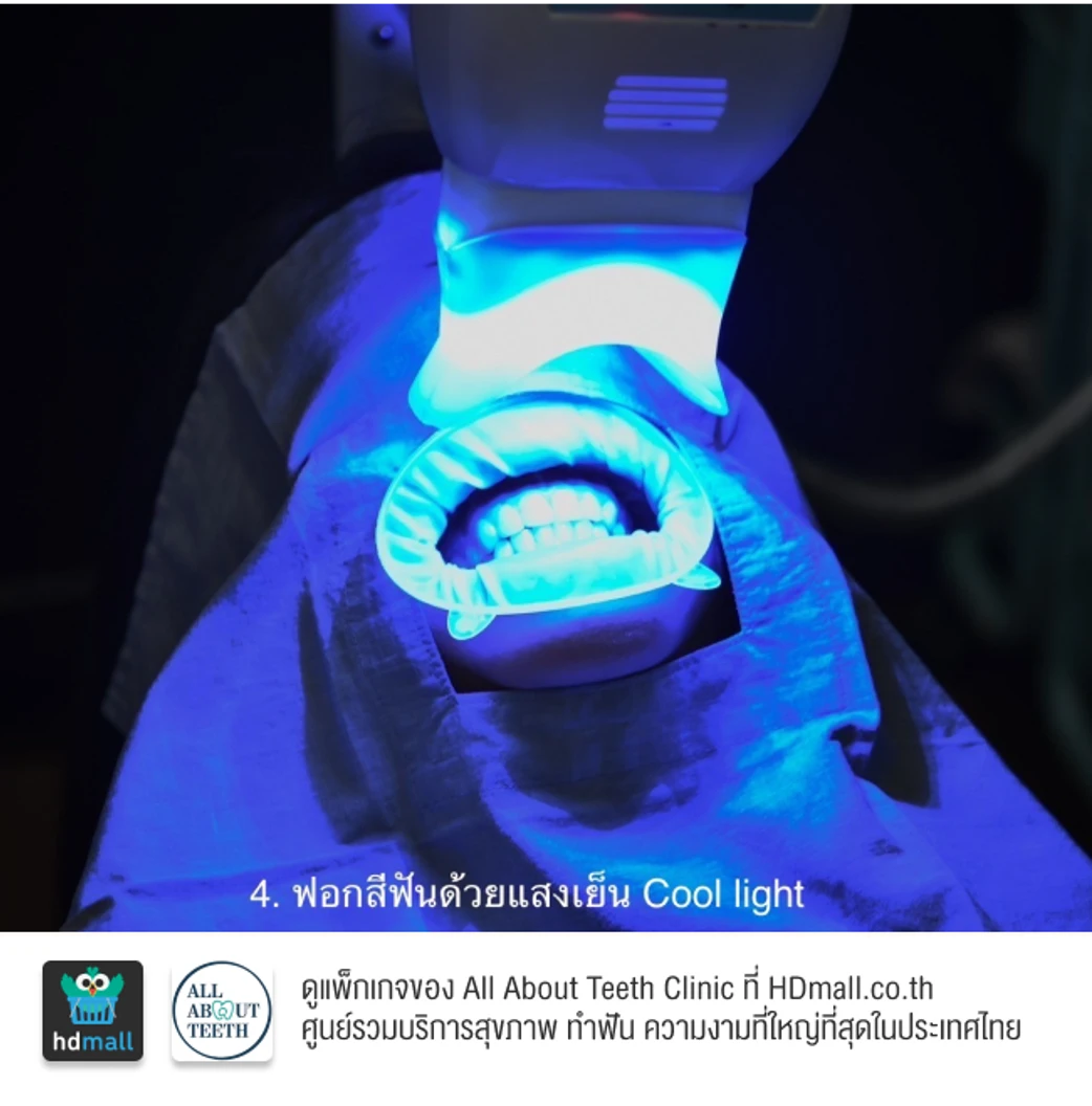 ฟอกสีฟันที่คลินิก ด้วยระบบ Cool Light พร้อมขัดฟันและเคลือบฟลูออไรด์