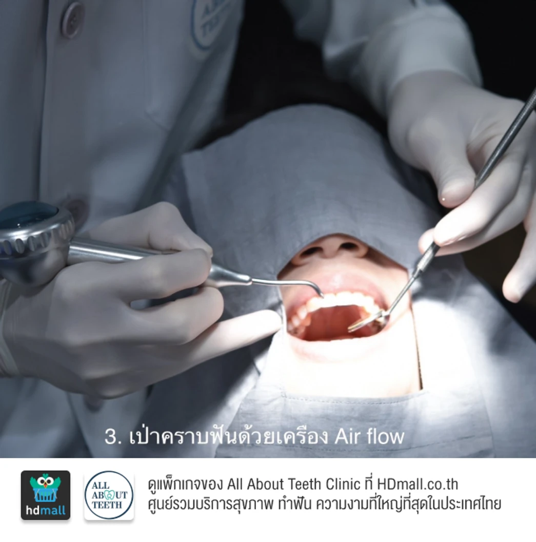 ฟอกสีฟันที่คลินิก ด้วยระบบ Cool Light พร้อมขัดฟันและเคลือบฟลูออไรด์