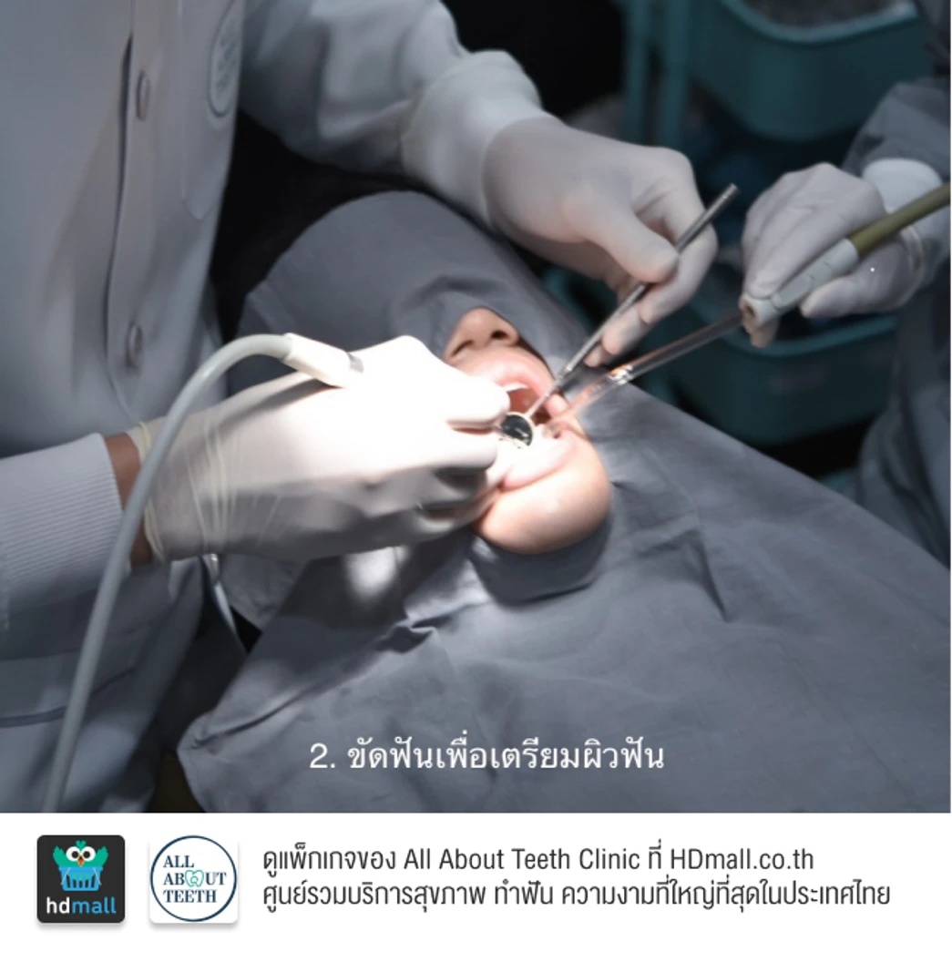 ฟอกสีฟันที่คลินิก ด้วยระบบ Cool Light พร้อมขัดฟันและเคลือบฟลูออไรด์