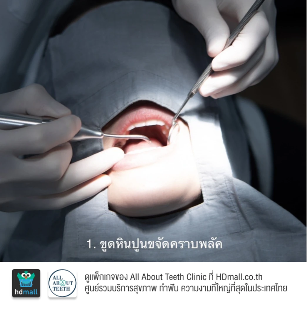 ฟอกสีฟันที่คลินิก ด้วยระบบ Cool Light พร้อมขัดฟันและเคลือบฟลูออไรด์