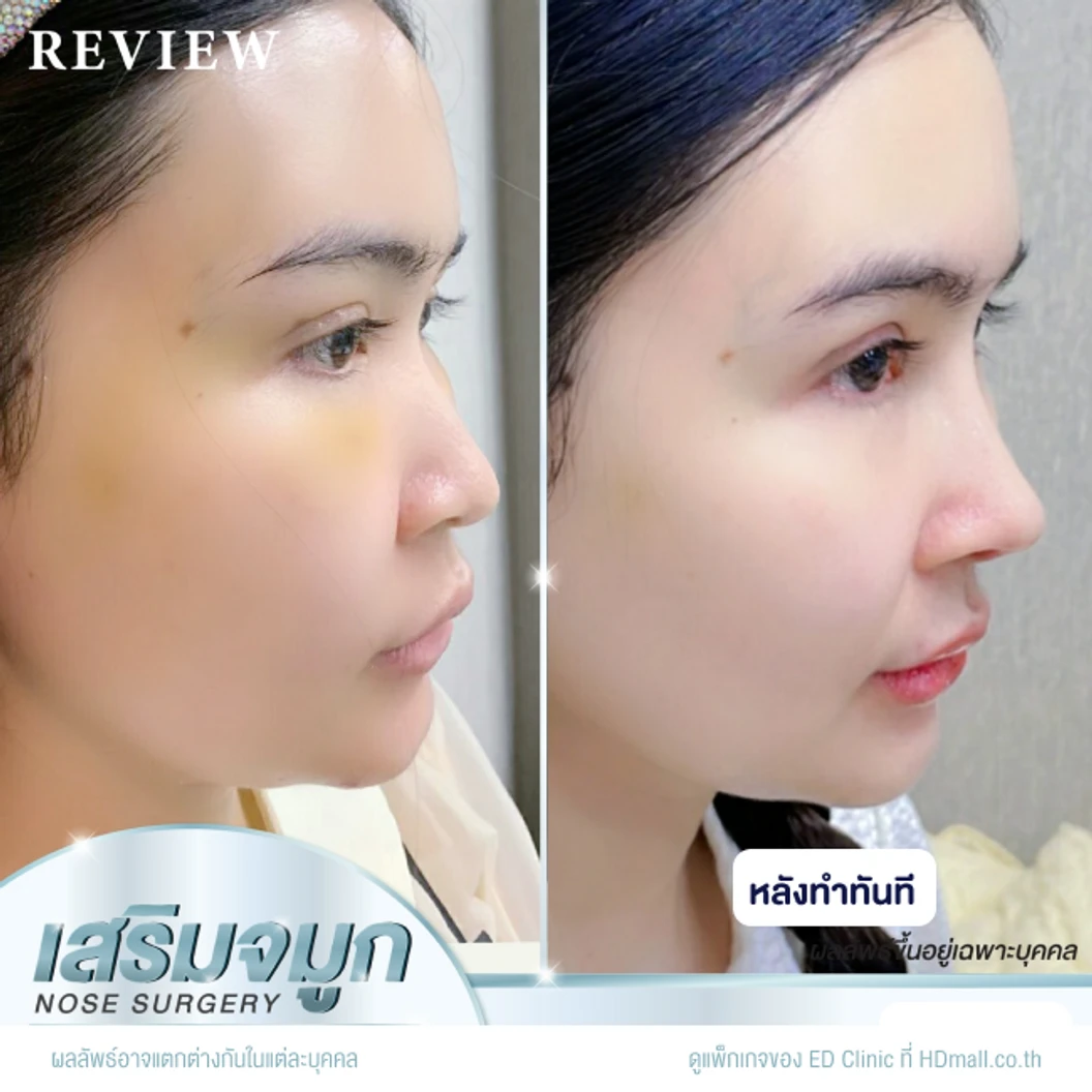 เสริมจมูก ด้วยซิลิโคนอเมริกา Mantis เทคนิค Semi-Open สำหรับเคสทำครั้งแรก