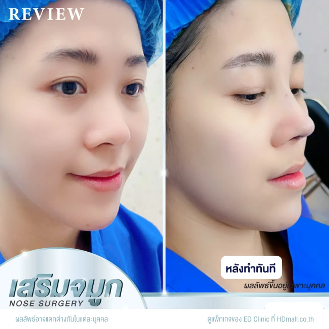 เสริมจมูก ด้วยซิลิโคนอเมริกา Mantis เทคนิค Semi-Open สำหรับเคสทำครั้งแรก