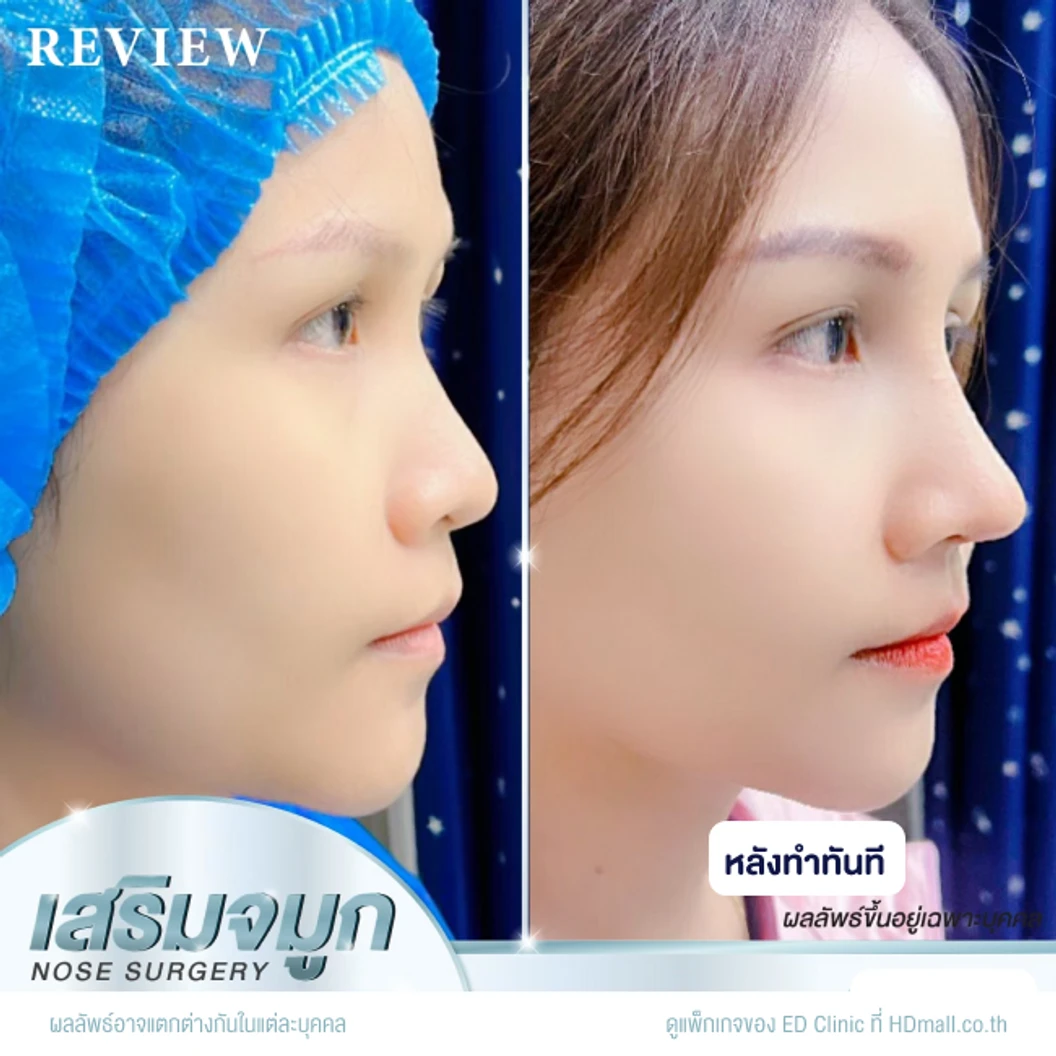 เสริมจมูก ด้วยซิลิโคนอเมริกา Mantis เทคนิค Semi-Open สำหรับเคสทำครั้งแรก