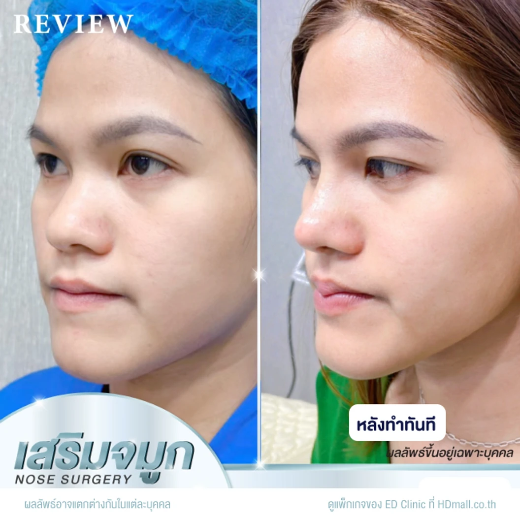 เสริมจมูก ด้วยซิลิโคนอเมริกา Mantis เทคนิค Semi-Open สำหรับเคสทำครั้งแรก