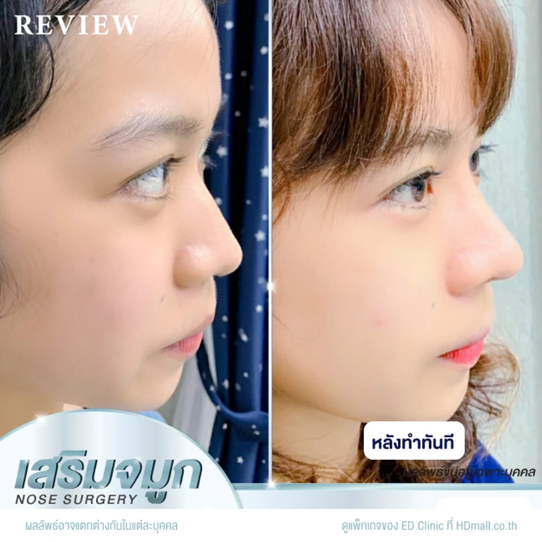เสริมจมูก ด้วยซิลิโคนอเมริกา Mantis เทคนิค Semi-Open สำหรับเคสทำครั้งแรก