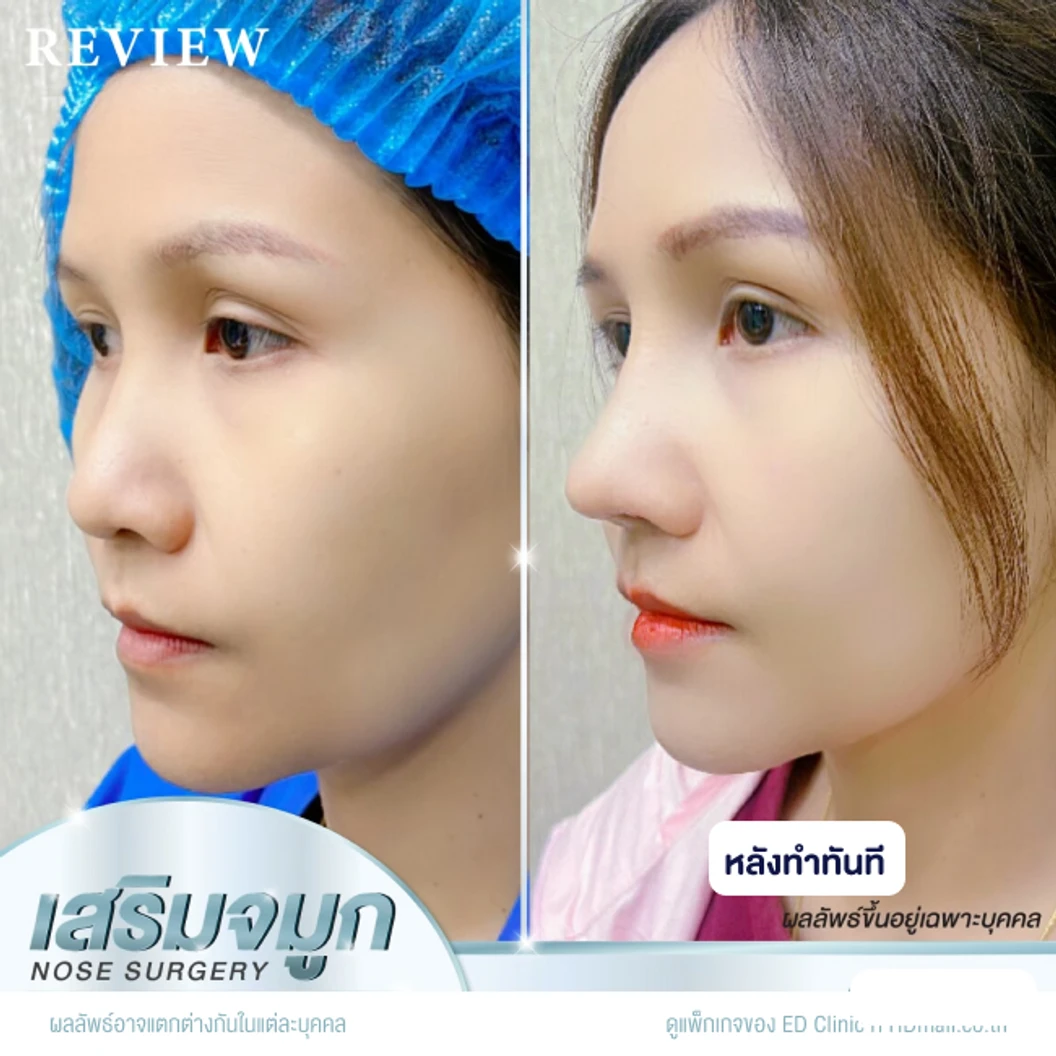 เสริมจมูก ด้วยซิลิโคนอเมริกา Mantis เทคนิค Semi-Open สำหรับเคสทำครั้งแรก