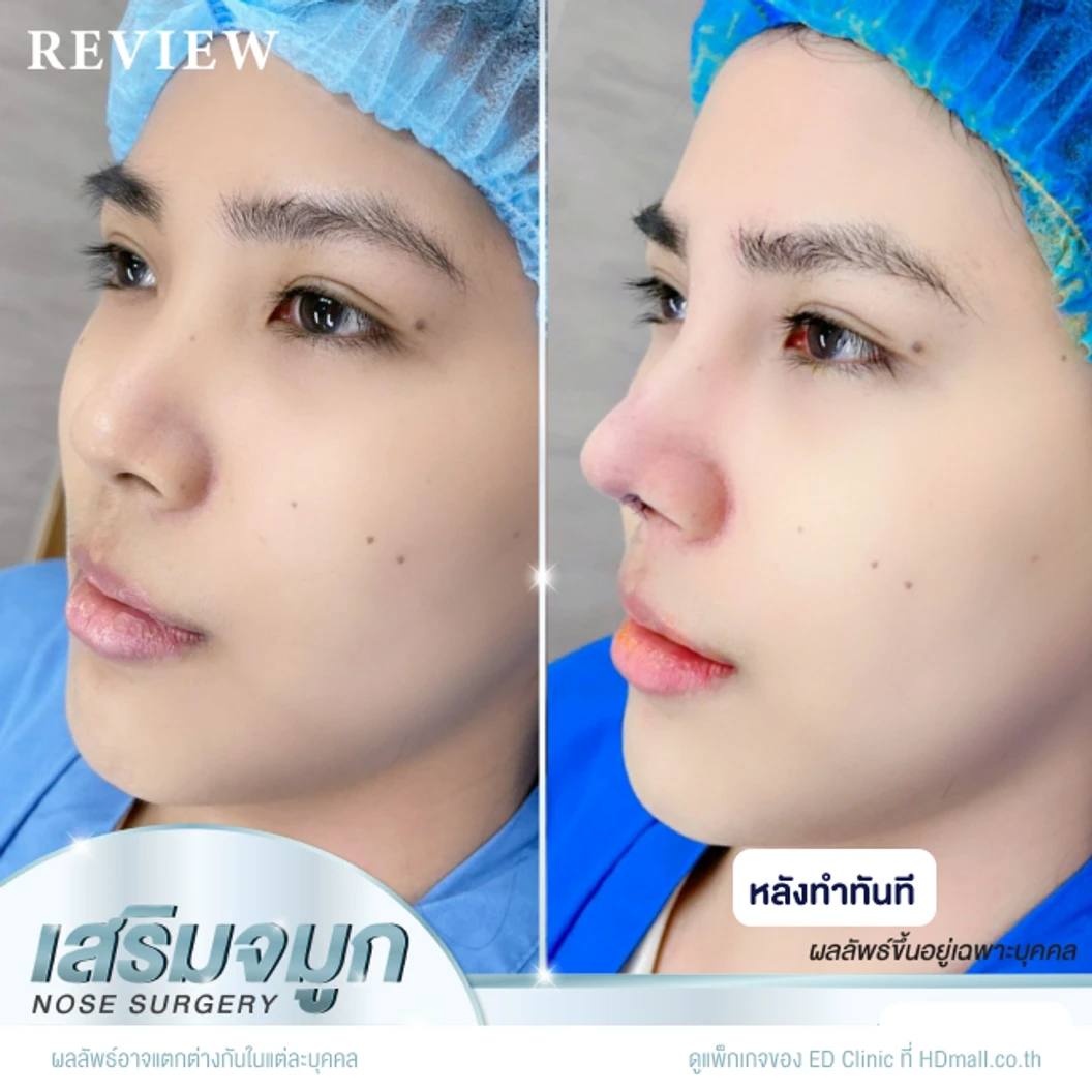 เสริมจมูก ด้วยซิลิโคนอเมริกา Mantis เทคนิค Semi-Open สำหรับเคสทำครั้งแรก