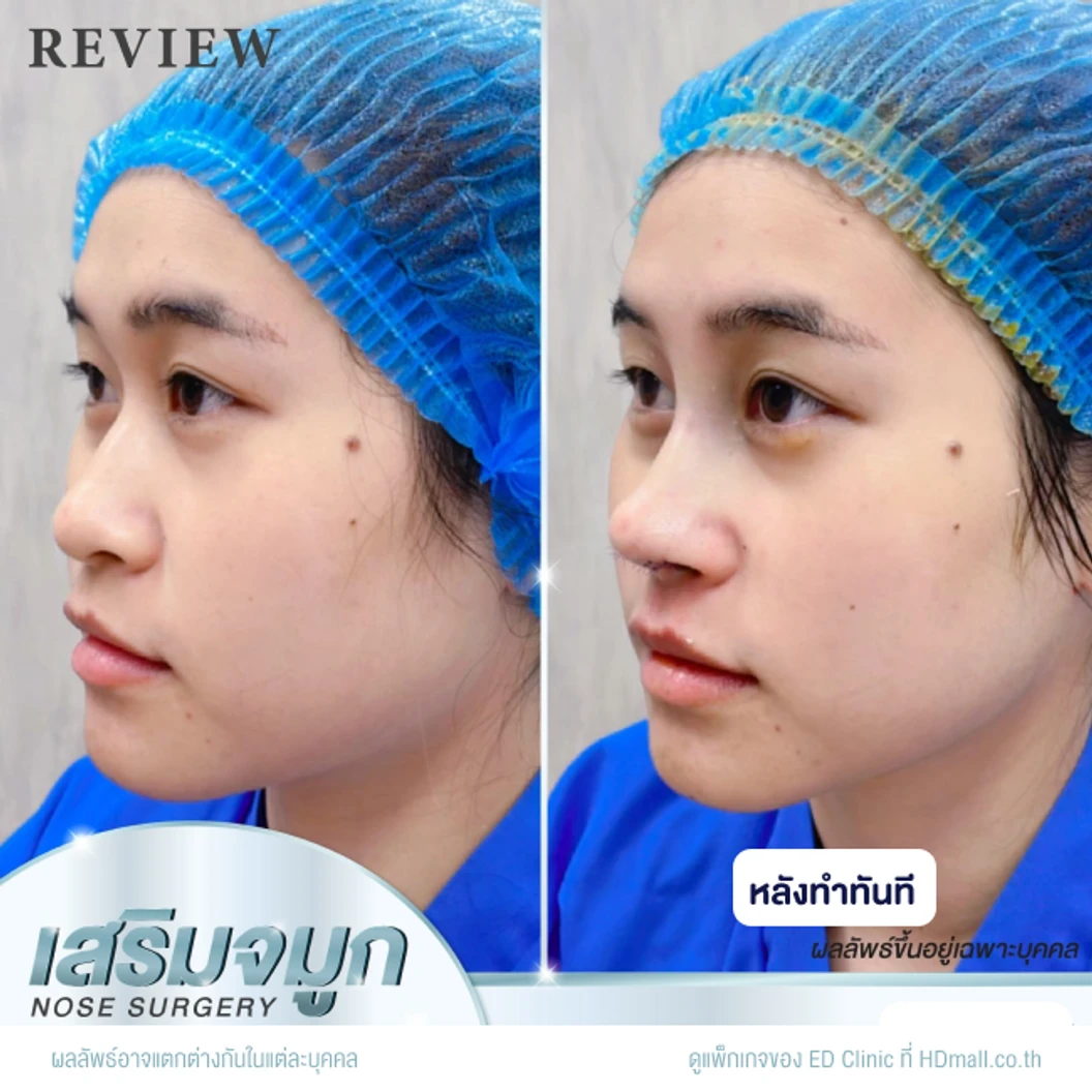 เสริมจมูก ด้วยซิลิโคนอเมริกา Mantis เทคนิค Semi-Open สำหรับเคสทำครั้งแรก