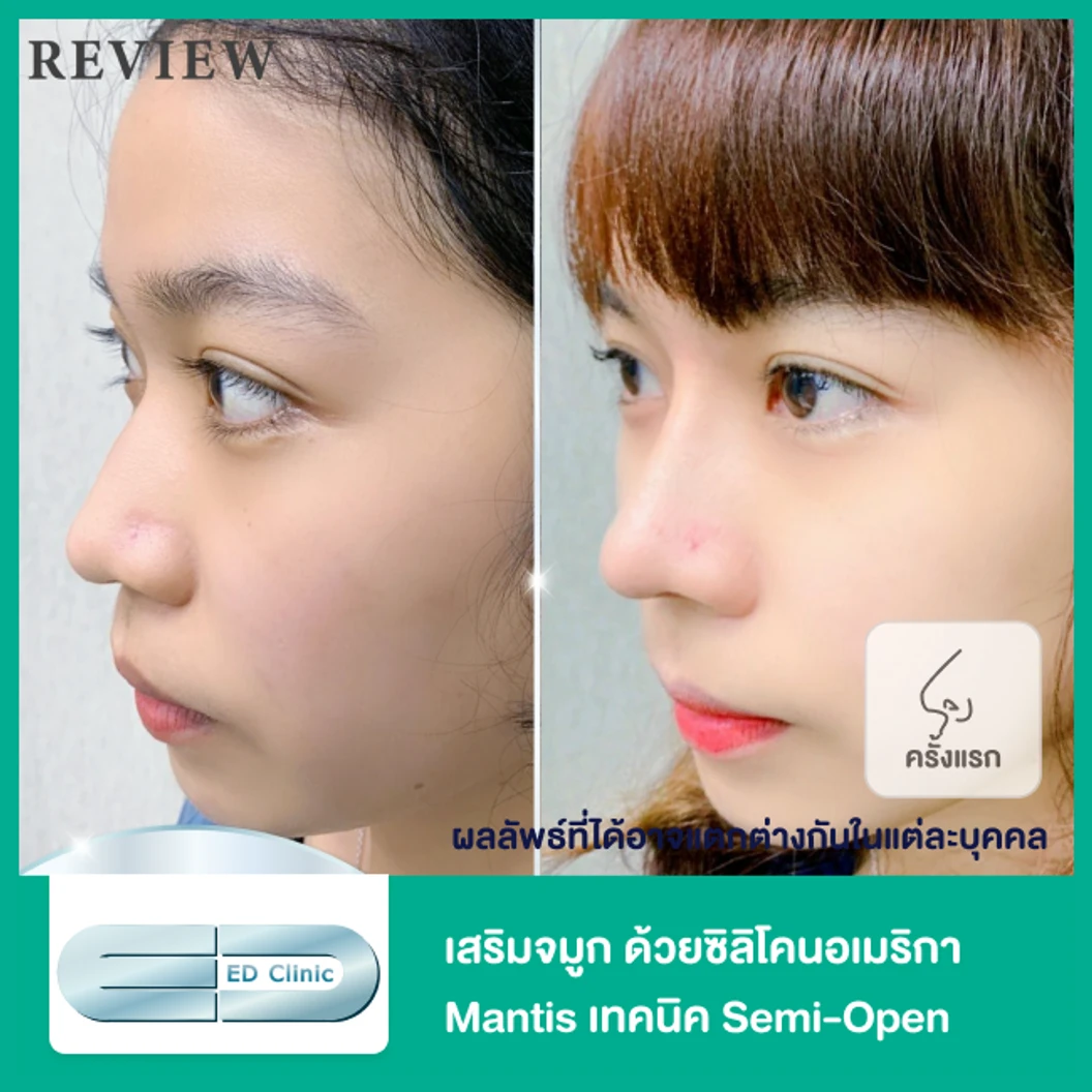 เสริมจมูก ด้วยซิลิโคนอเมริกา Mantis เทคนิค Semi-Open สำหรับเคสทำครั้งแรก
