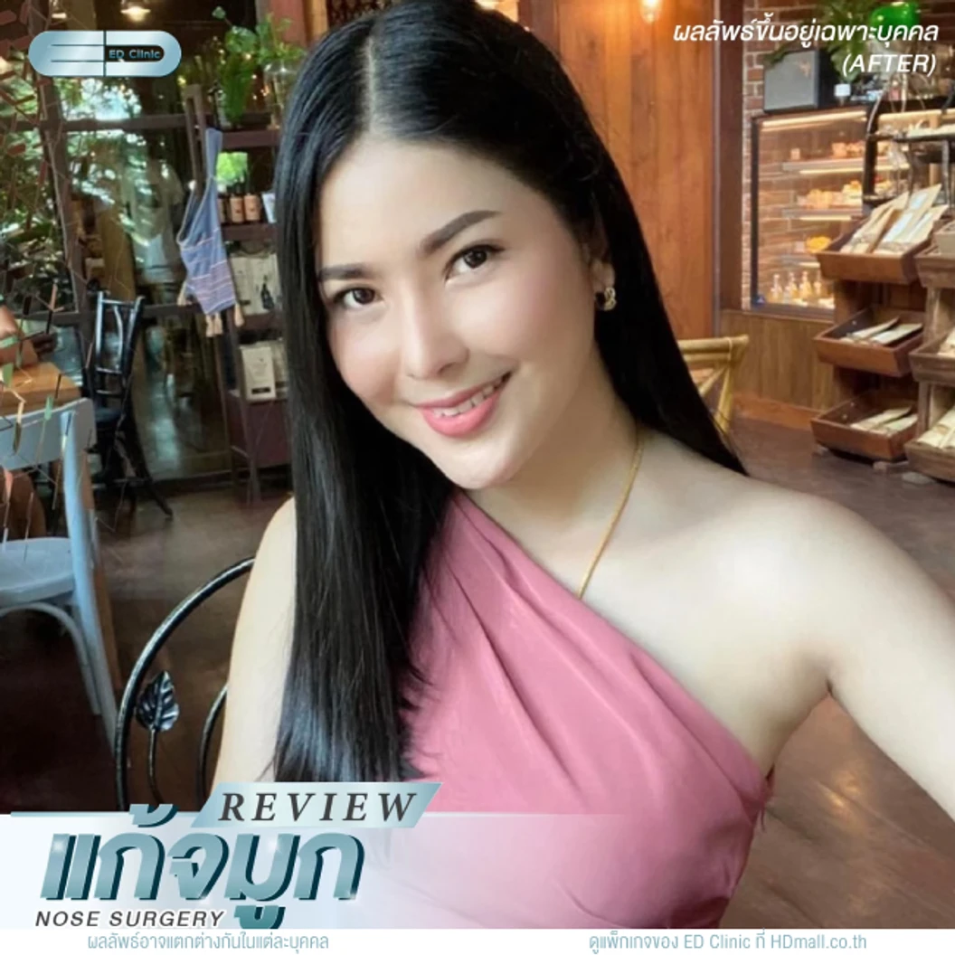 แก้จมูก เทคนิค Semi-Open ด้วยซิลิโคนอเมริกา Mantis