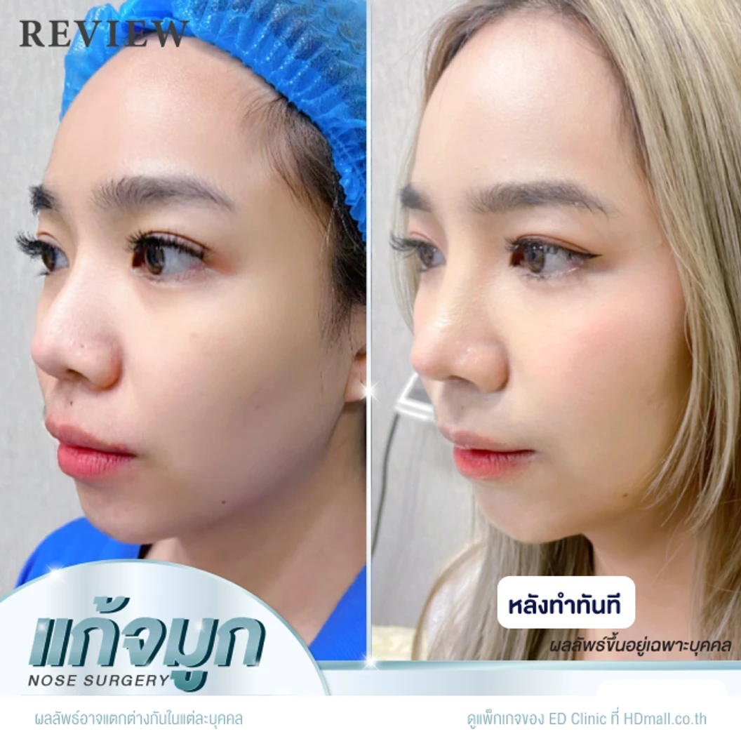 แก้จมูก เทคนิค Semi-Open ด้วยซิลิโคนอเมริกา Mantis