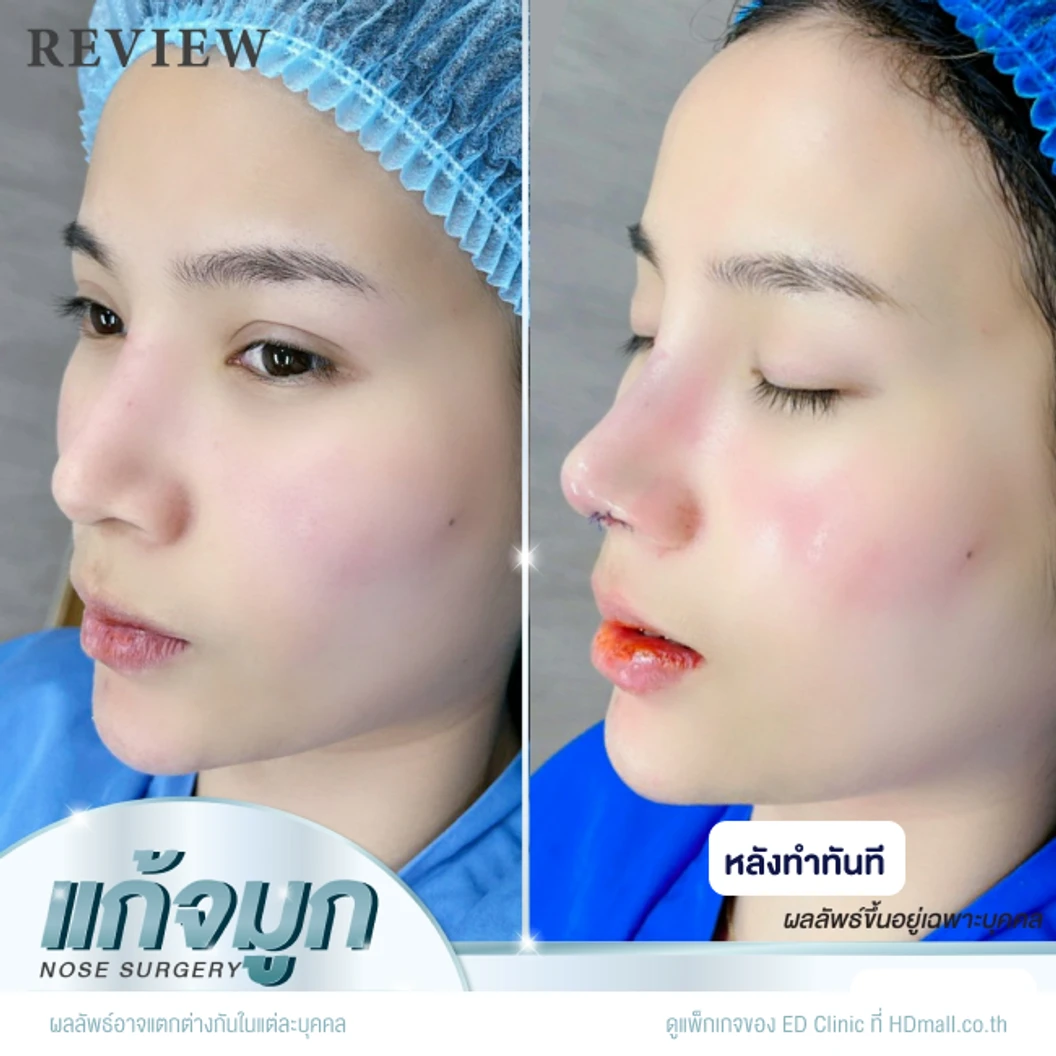 แก้จมูก เทคนิค Semi-Open ด้วยซิลิโคนอเมริกา Mantis