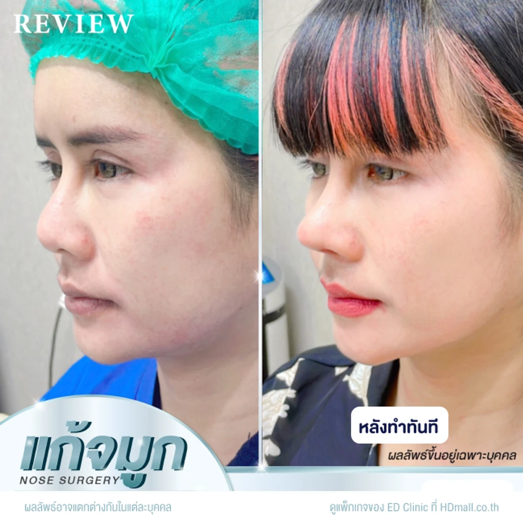 แก้จมูก เทคนิค Semi-Open ด้วยซิลิโคนอเมริกา Mantis