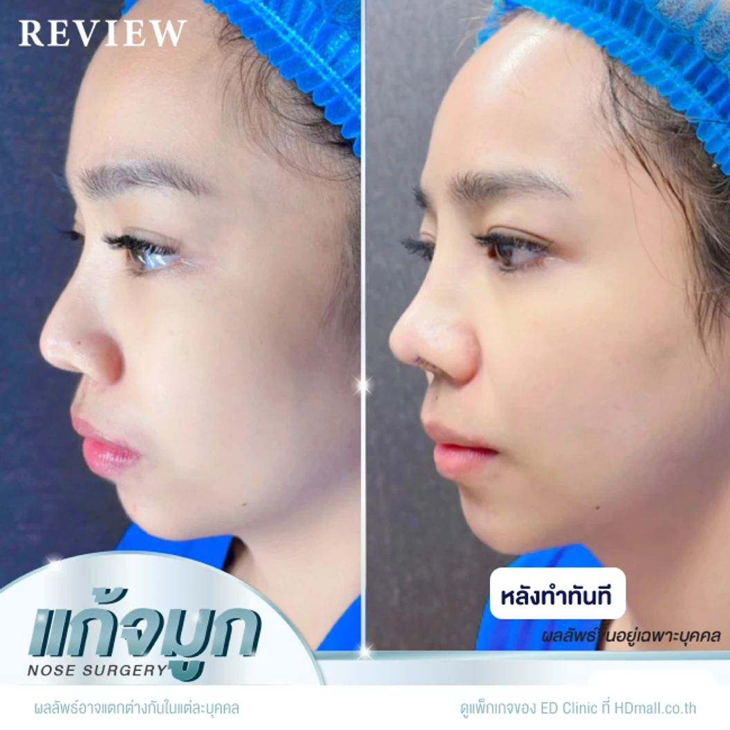 แก้จมูก เทคนิค Semi-Open ด้วยซิลิโคนอเมริกา Mantis