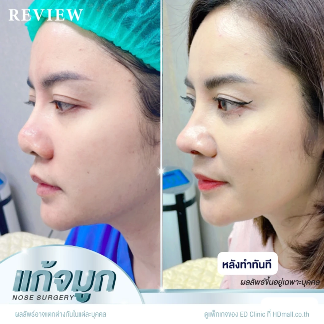 แก้จมูก เทคนิค Semi-Open ด้วยซิลิโคนอเมริกา Mantis