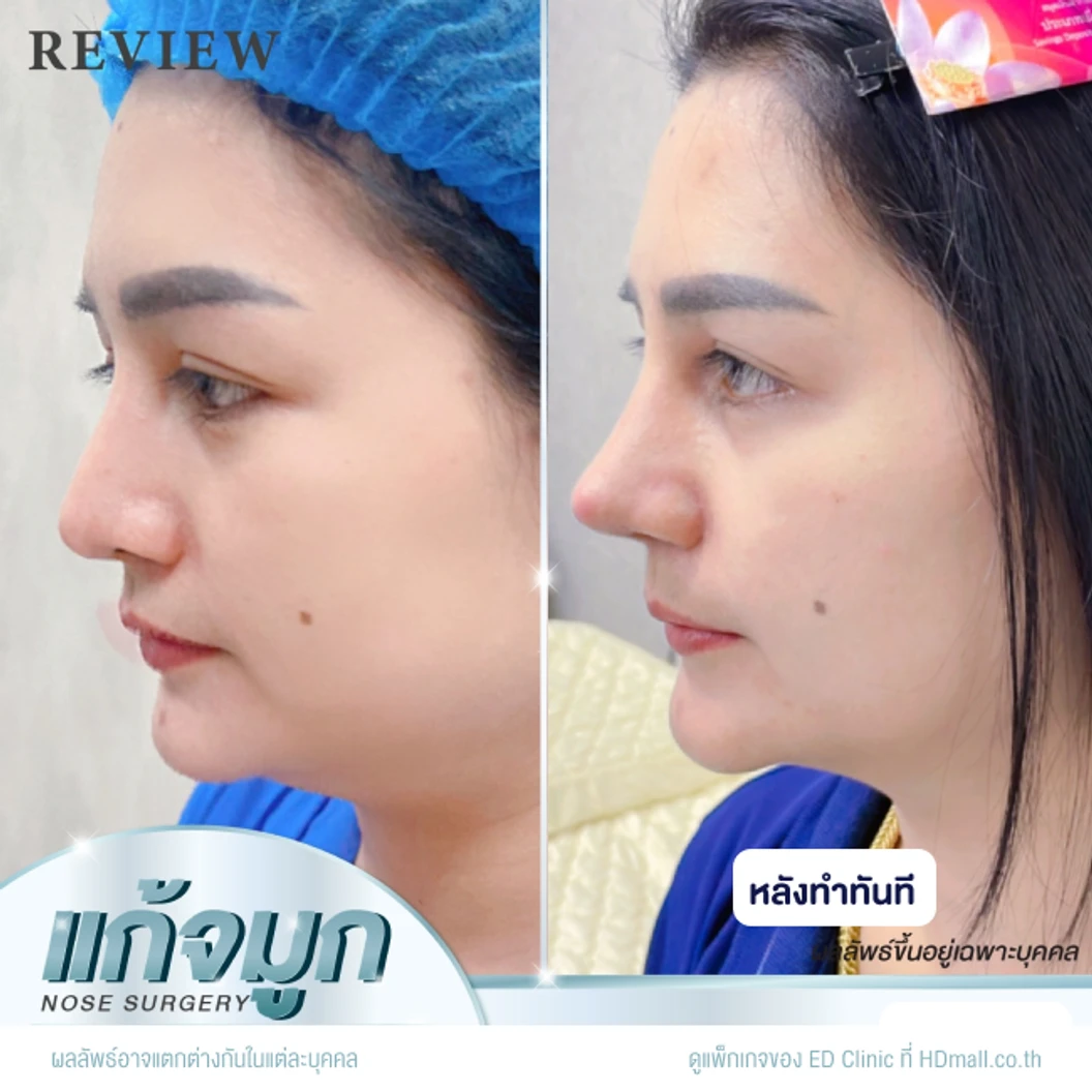 แก้จมูก เทคนิค Semi-Open ด้วยซิลิโคนอเมริกา Mantis