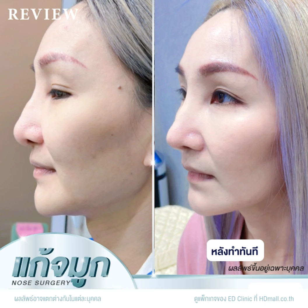 แก้จมูก เทคนิค Semi-Open ด้วยซิลิโคนอเมริกา Mantis