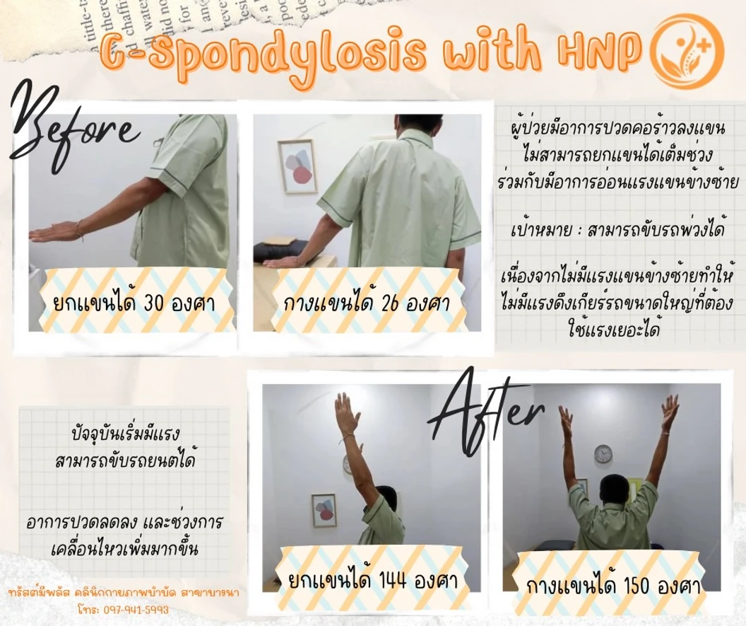 โปรแกรมกายภาพบำบัด บรรเทาอาการไหล่ติด 1 ครั้ง