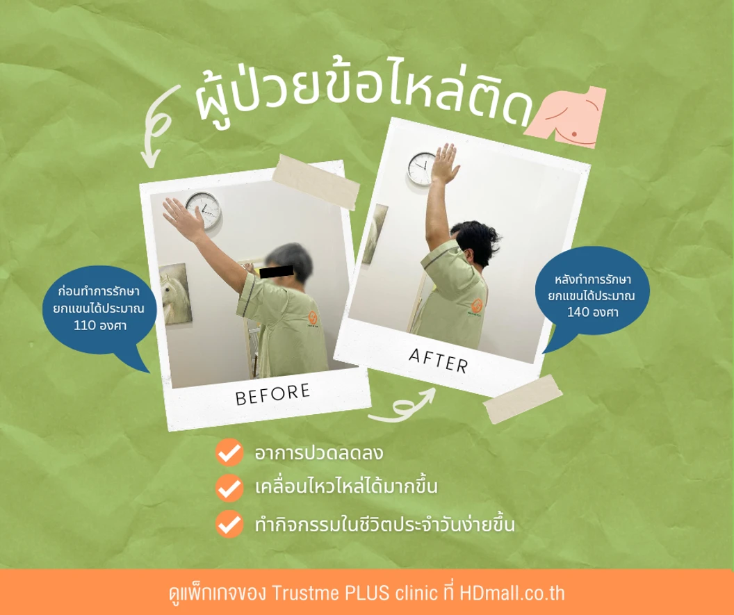 โปรแกรมกายภาพบำบัด บรรเทาอาการไหล่ติด 1 ครั้ง