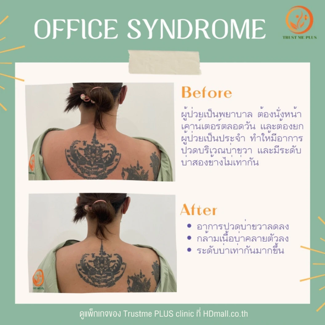 โปรแกรมกายภาพบำบัด บรรเทาอาการออฟฟิศซินโดรม ปวดคอ บ่า ไหล่ 1 ครั้ง