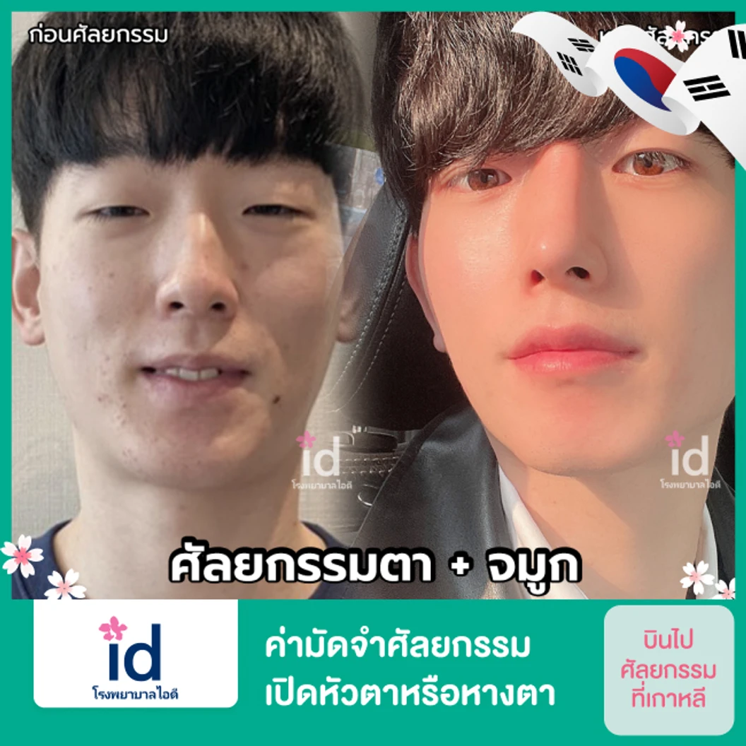 ค่ามัดจำศัลยกรรมเปิดหัวตาหรือหางตา สำหรับเคสทำครั้งแรก