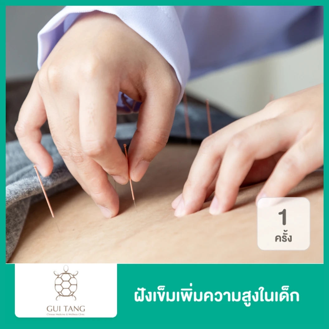 ฝังเข็มเพิ่มความสูงในเด็ก 1 ครั้ง