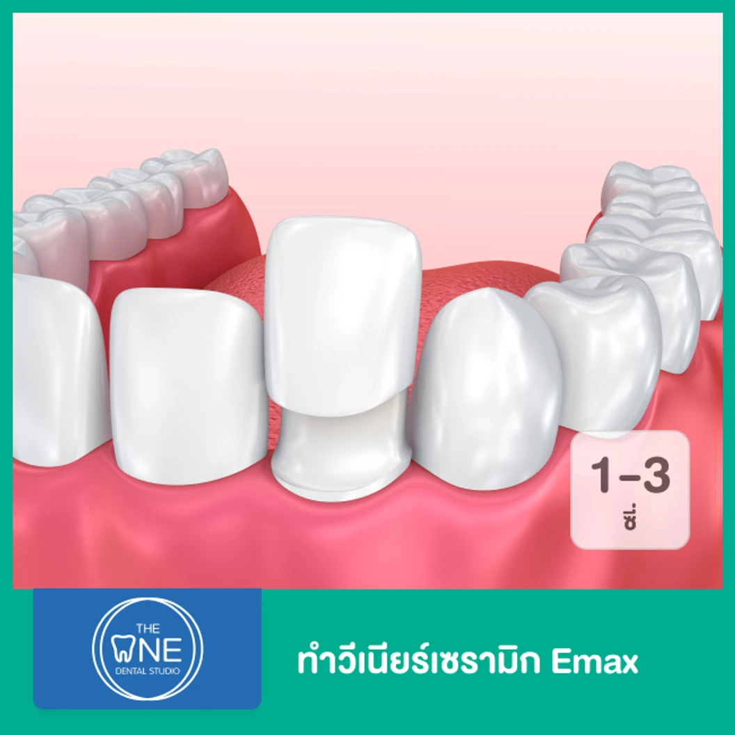 ทำวีเนียร์เซรามิก Emax 3 ซี่ ขึ้นไป ราคาต่อซี่