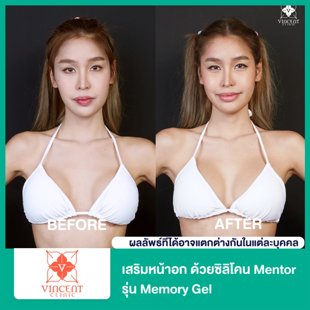 เสริมหน้าอก ด้วยซิลิโคน Mentor รุ่น Memory Gel ไม่จำกัดซีซี ขึ้นอยู่กับแพทย์ประเมิน สำหรับเคสทำครั้งแรก ที่ Vincent Clinic