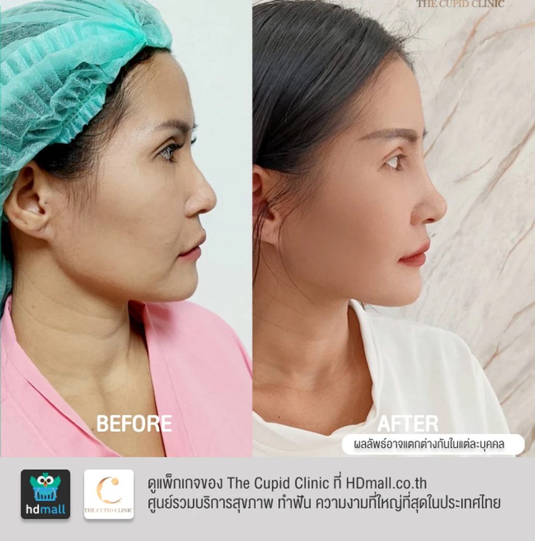 เสริมจมูก ด้วยซิลิโคนอเมริกา Mantis เทคนิค Double Lock สำหรับเคสทำครั้งแรก