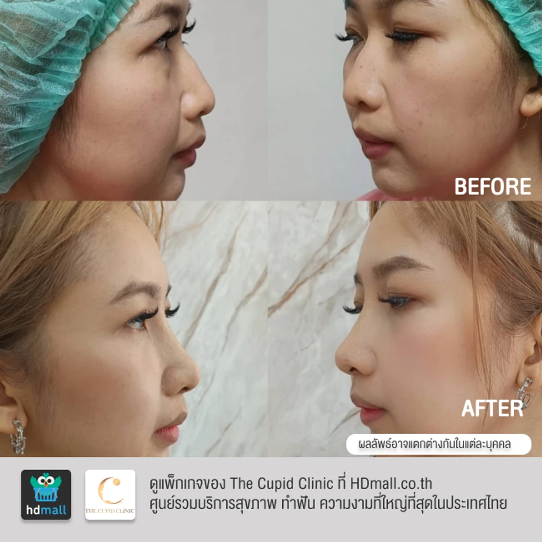 เสริมจมูก ด้วยซิลิโคนอเมริกา Mantis เทคนิค Double Lock สำหรับเคสทำครั้งแรก