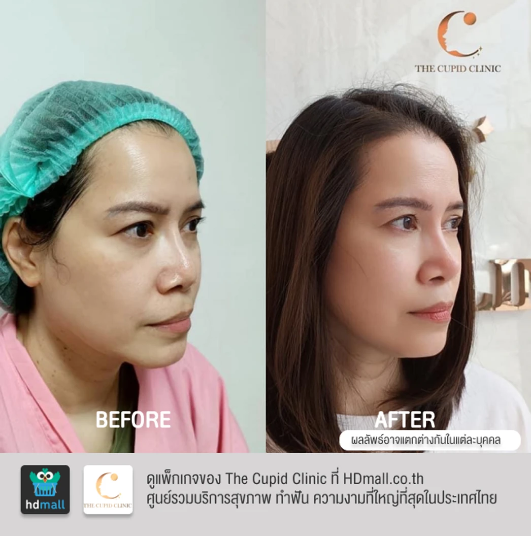 เสริมจมูก ด้วยซิลิโคนอเมริกา Mantis เทคนิค Double Lock สำหรับเคสทำครั้งแรก