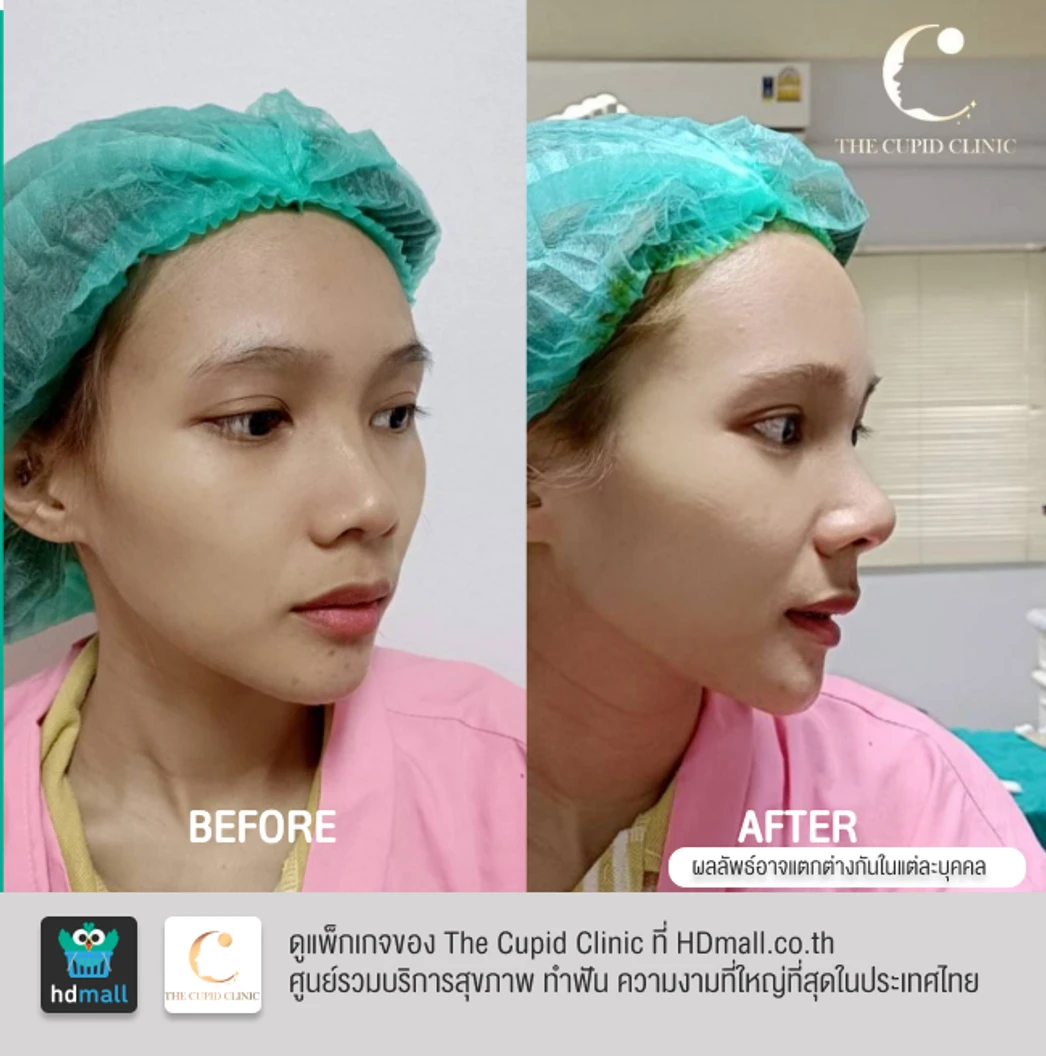 เสริมจมูก ด้วยซิลิโคนอเมริกา Mantis เทคนิค Double Lock สำหรับเคสทำครั้งแรก