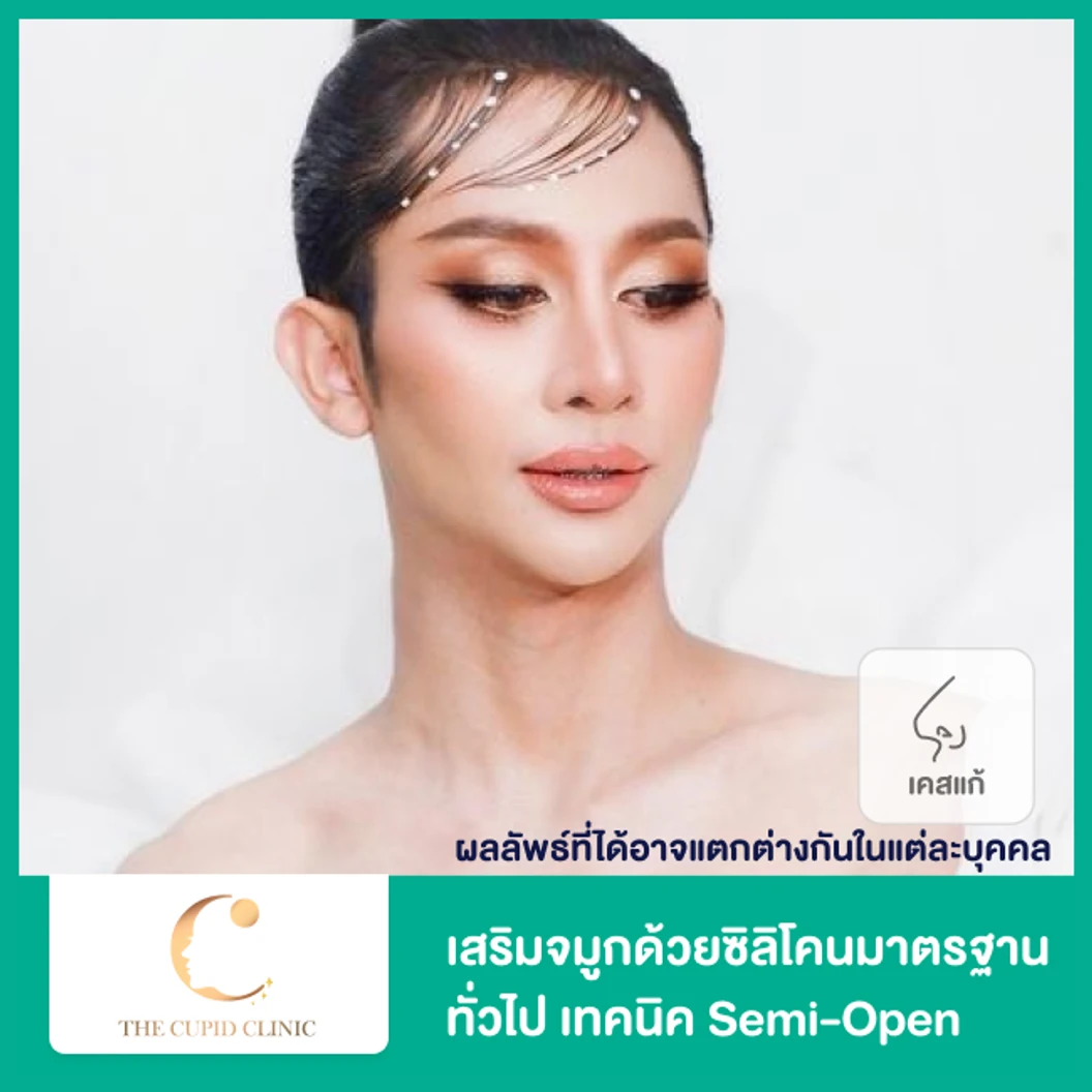 เสริมจมูก ด้วยซิลิโคนอเมริกา Mantis เทคนิค Double Lock สำหรับเคสทำครั้งแรก