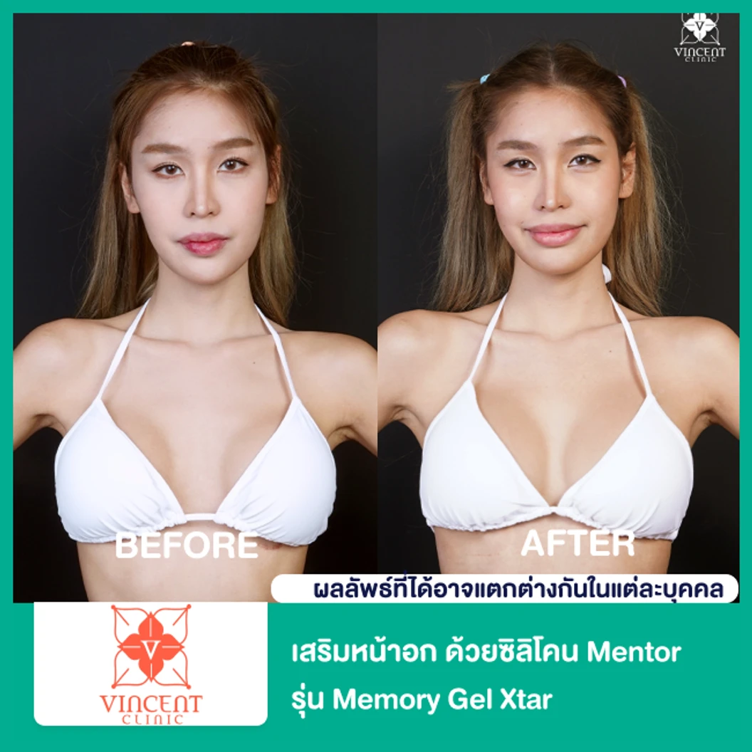 เสริมหน้าอก ด้วยซิลิโคน Mentor รุ่น Memory Gel Xtar ไม่จำกัดซีซี ขึ้นอยู่กับแพทย์ประเมิน สำหรับเคสทำครั้งแรก ที่ Vincent Clinic
