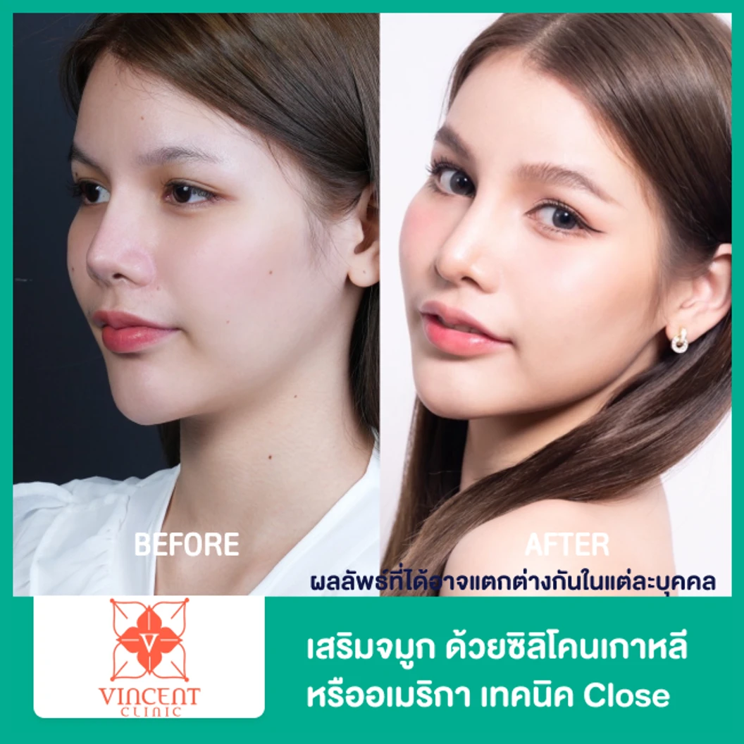 เสริมจมูก ด้วยซิลิโคนเกาหลีหรืออเมริกา เทคนิค Close สำหรับเคสแก้
