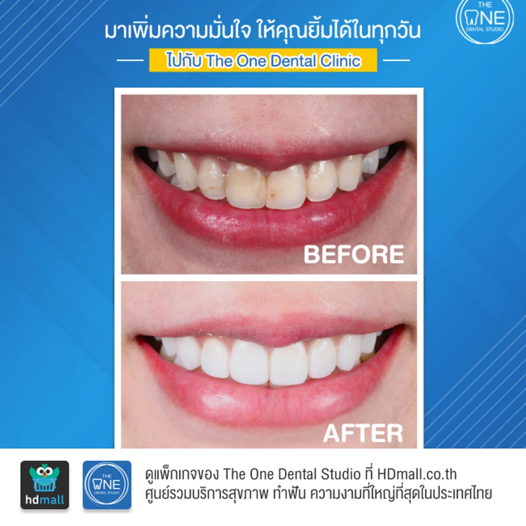 ทำวีเนียร์เซรามิก Emax 4 ซี่ ขึ้นไป ราคาต่อซี่