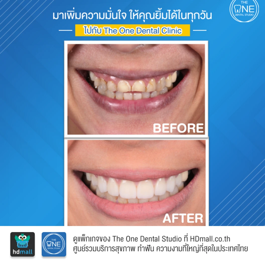 ทำวีเนียร์เซรามิก Emax 4 ซี่ ขึ้นไป ราคาต่อซี่