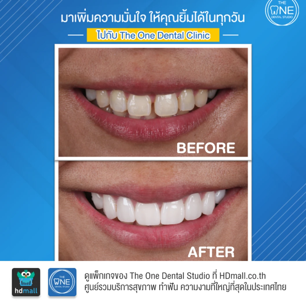 ทำวีเนียร์เซรามิก Emax 4 ซี่ ขึ้นไป ราคาต่อซี่