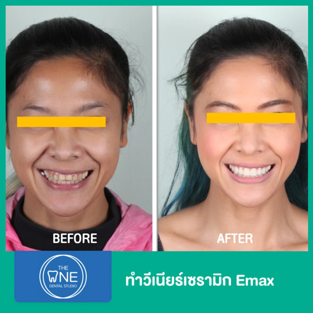 ทำวีเนียร์เซรามิก Emax 4 ซี่ ขึ้นไป ราคาต่อซี่