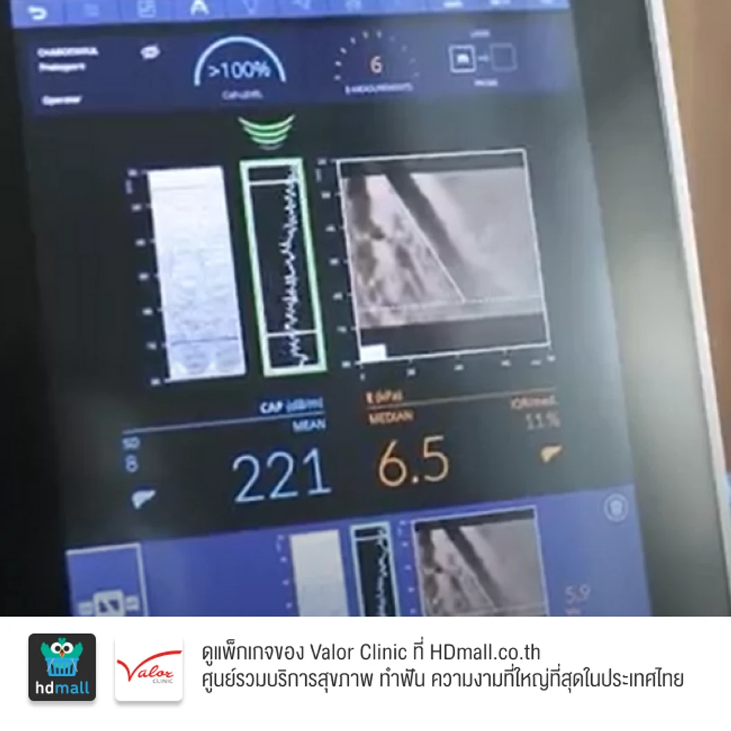 ตรวจภาวะพังผืดในตับและไขมันพอกตับ ด้วยเครื่องไฟโบรสแกน (FibroScan)